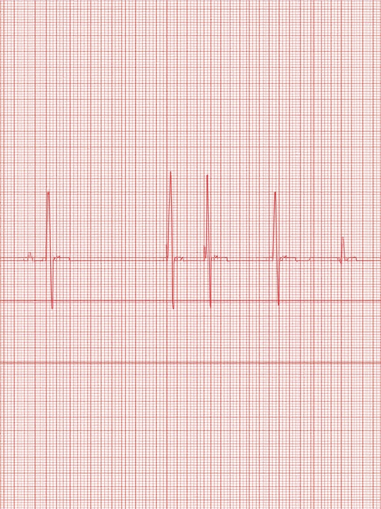 ECG anomalies - Interprétation de l'ECG : anomalies fréquentes